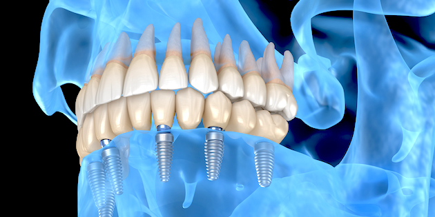 Nuevos estudios aumentan la viabilidad de los implantes dentales que alojan dispositivos auditivos