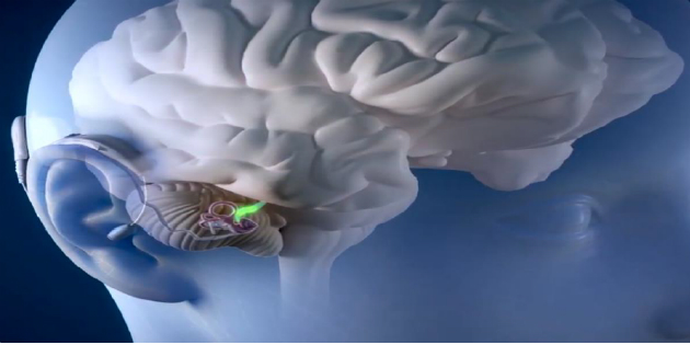 El implante coclear y sus implicaciones en el diagnóstico por imagen El implante coclear y sus implicaciones en el diagnóstico por imagen